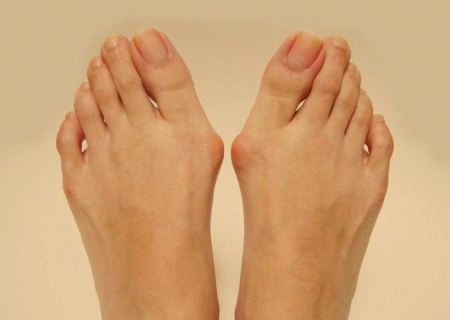Bunions