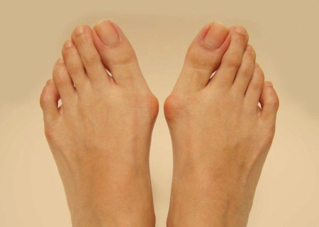 Bunions