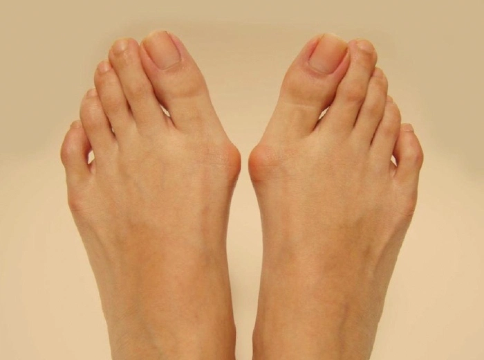 Bunions: That Bony Lump on Your Foot Is Trying to Tell You Something, Bro